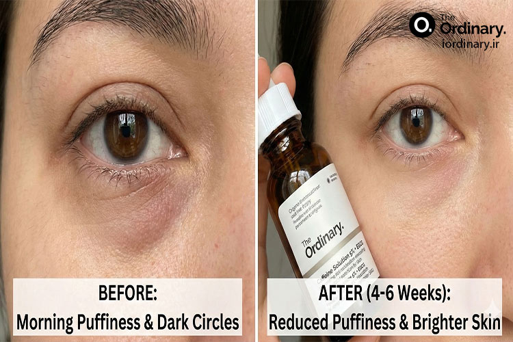 نتایج استفاده از سرم کافئین اوردینری (بررسی قبل و بعد مشتریان)