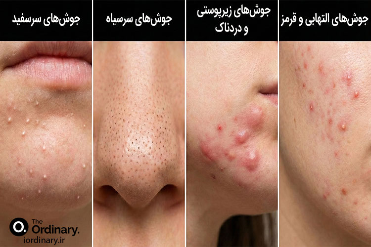 انواع جوش صورت و روش تشخیص آنها
