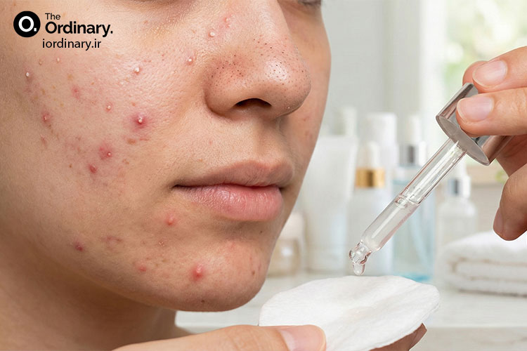 درمان انواع جوش و آکنه