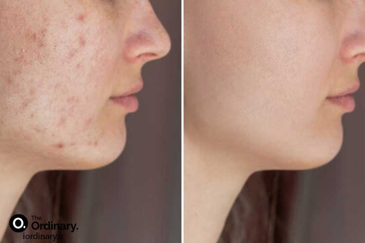 The Ordinary anti acne serum skin 2