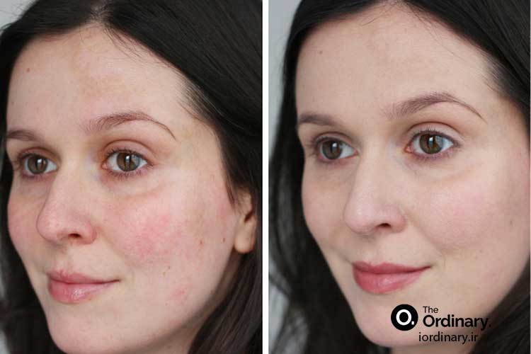 مزایای استفاده از سرم مرطوب کننده و آبرسان اوردینری