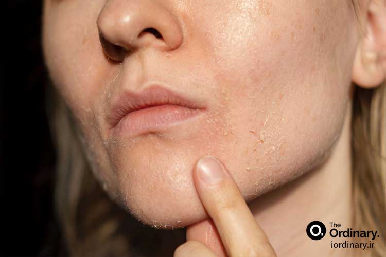 روتین ایده‌آل برای شفافیت و رفع لک با لایه بردارهای اوردینری