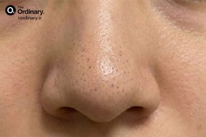 درمان قطعی جوش سرسیاه بینی